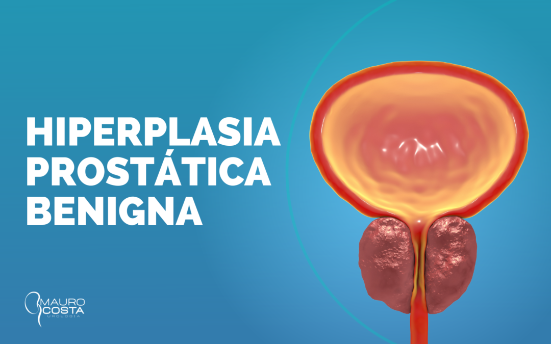 Hiperplasia Prostática Benigna