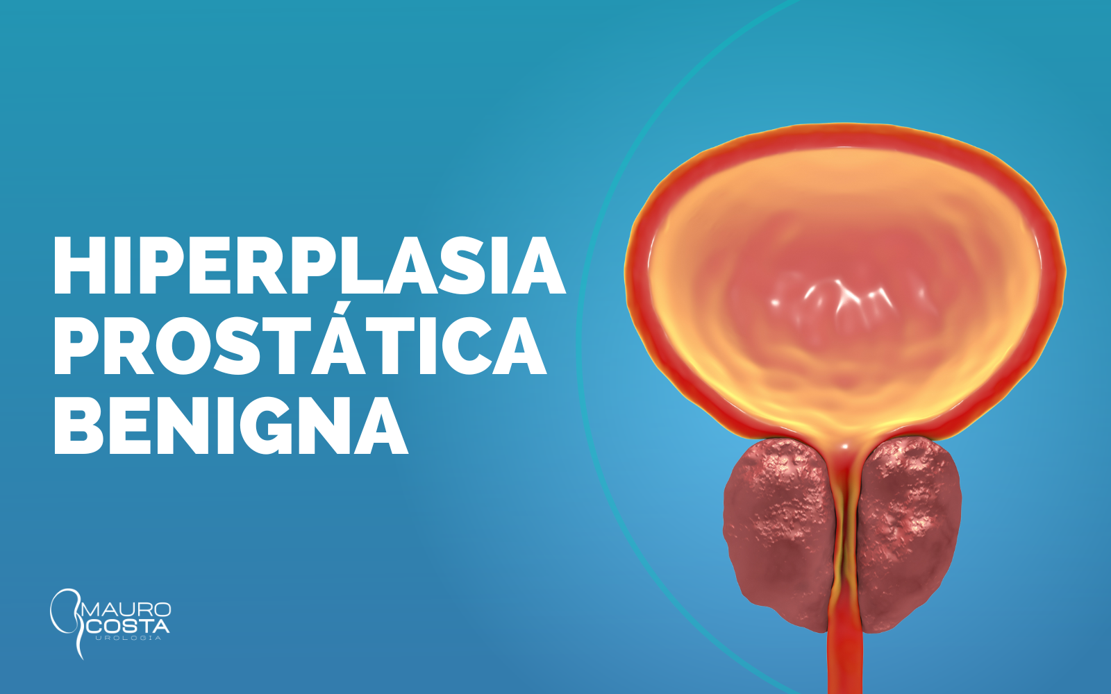 Hiperplasia Prostática Benigna Dr Mauro Costa